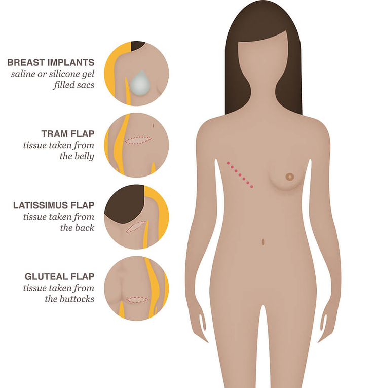 Empowering Breast Cancer Survivors: The Comprehensive Guide to Breast Implant Reconstruction